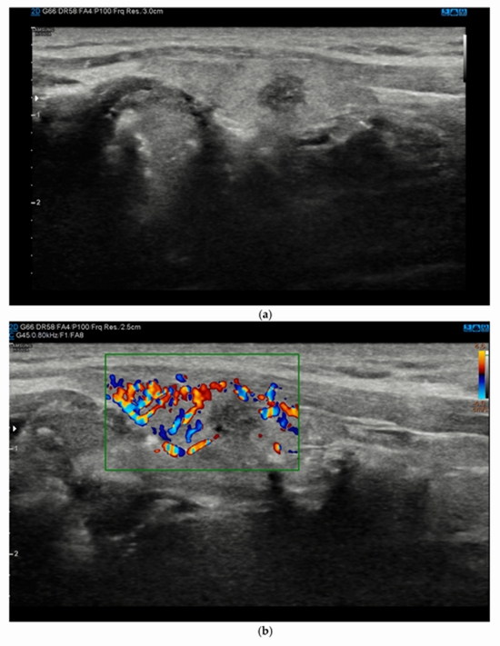  detecting malignant thyroid no {faces}